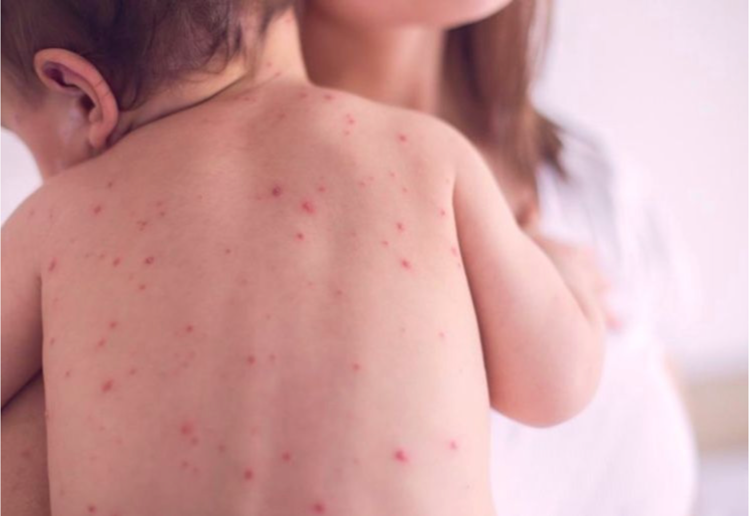 Өнгөрсөн 24 цагийн дотор Улаанбурхан өвчний 18 тохиолдол шинээр батлагджээ